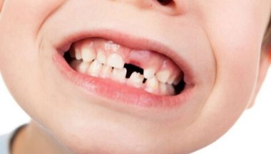 Sonhar com dente caindo