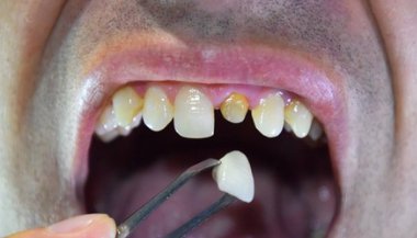 Sonhar com dente podre