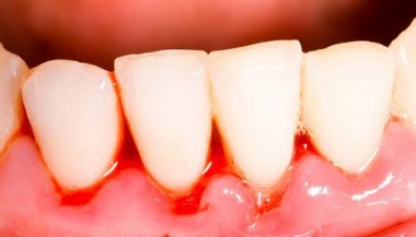 Sonhar com dente sangrando