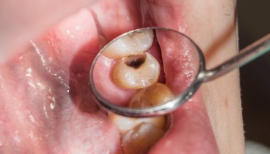 Sonhar com dente cariado