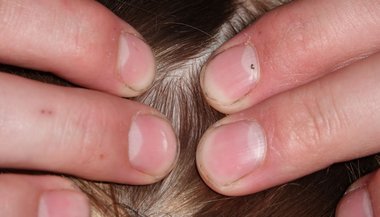 Sonhar com piolho na cabeça de outra pessoa