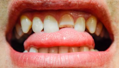 Sonhar com dente quebrando