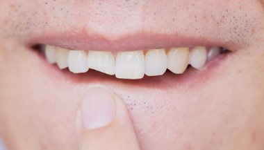 Sonhar com dente quebrado