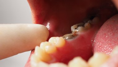 Sonhar com dente estragado