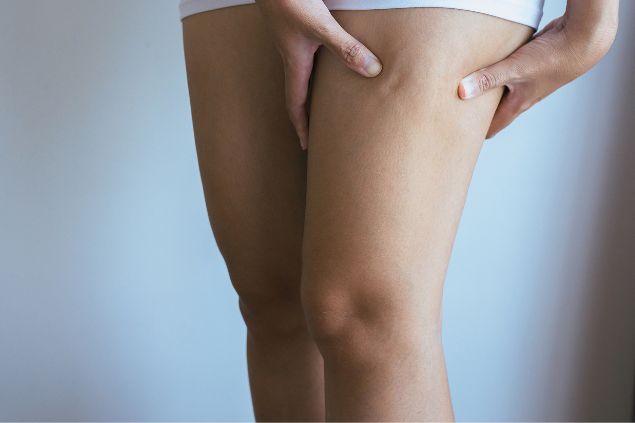 Mulher mostrando a celulite na coxa